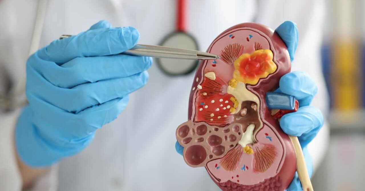 what-is-kidney-failure-healthcare-nt-sickcare