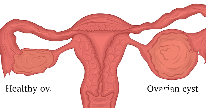 Sebaceous Cyst Test ₹1999 Healthcare Nt Sickcare