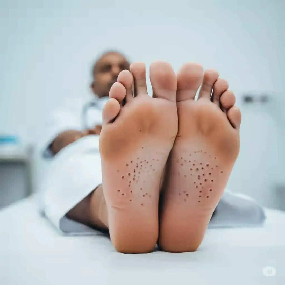 Pitted keratolysis treatment and causes guide for foot infection care in Pune