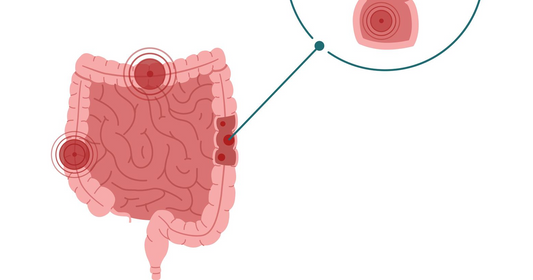 What is Sibo? Small Intestinal Bacterial Overgrowth healthcare nt sickcare