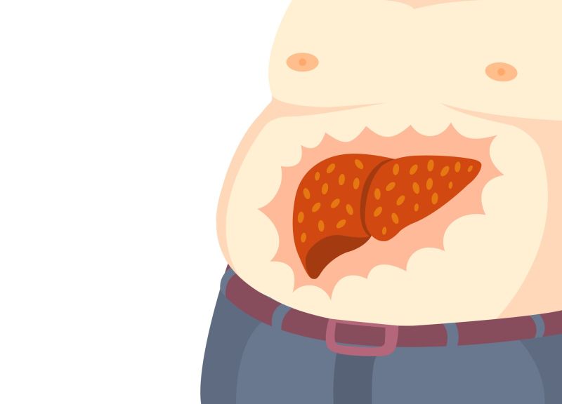 What is a Fatty Liver Disease? A Deeper Understanding healthcare nt sickcare