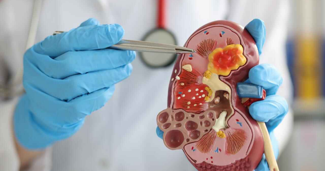 Symptoms and Early Signs of Kidney Failure