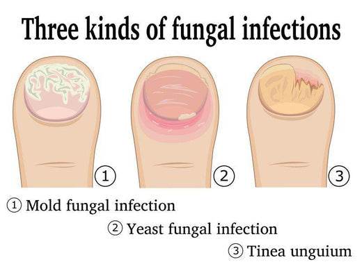 What are the 4 Types of Fungal Infections? - healthcare nt sickcare