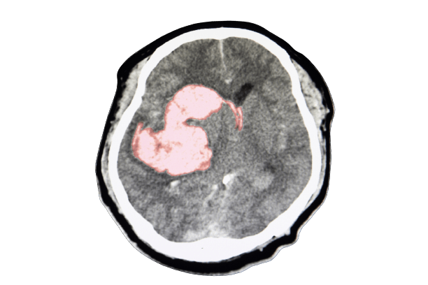 Thrombophilia Tests and Packages - healthcare nt sickcare