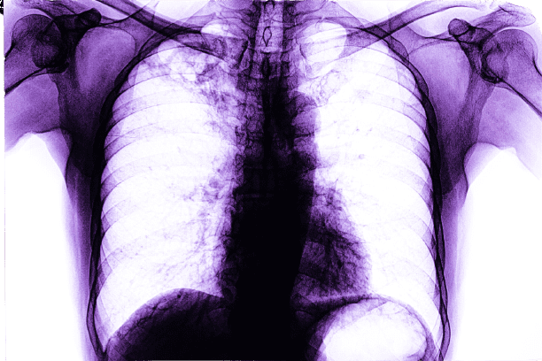 AFB Detection Sputum Test - healthcare nt sickcare