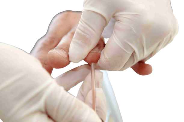 Serum Ketone Test (Blood Ketones) - healthcare nt sickcare